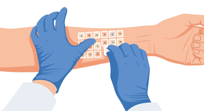 Medical hands wearing blue nitrile gloves carefully apply a grid of small adhesive allergy test patches to a patient's forearm for diagnostic purposes.