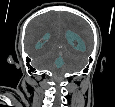 3D CT Scan of Cranium Showing Intracranial Hemorrhage
