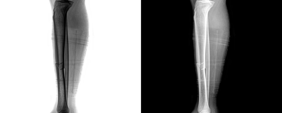 Medical Leg Lateral View X-ray Image Showing Clear Visualization of Long Bones for Assessment of Fractures and Bone Integrity Isolated on Transparent Background
