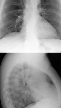 Chest radiograph anterior posterior lateral views healthy human lungs heart structure medical education pulmonary diagnostic radiology clinical evaluation respiratory system assessment skeletal anatom