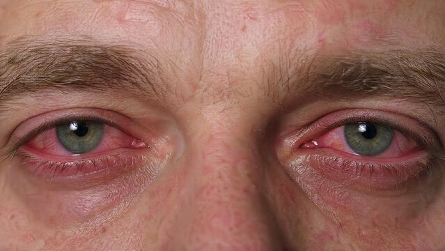 Close-up of Red Bloodshot Eyes with Conjunctivitis or Allergic Reaction