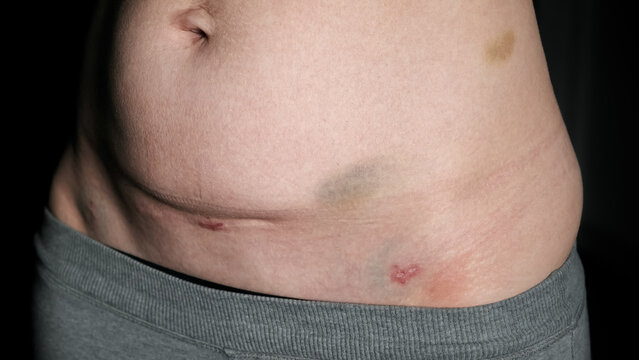 Fresh medical scars on female abdomen after laparoscopic surgery. Stretch marks on light caucasian skin after cesarean section on dark background. Body Lymphatic edema. Maternity concept. Front view.