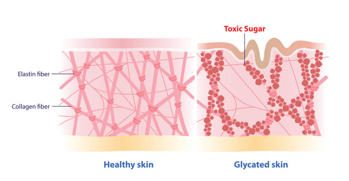 Comparison of healthy and glycated skin illustration. The glycation skin, excess sugar molecules bind to protein such as collagen and elastin, resulting in premature aging, sagging, wrinkles and dull.