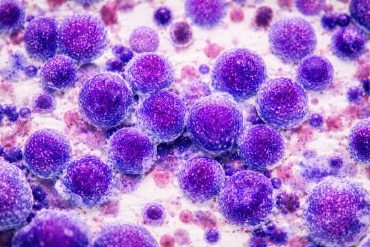 Photomicrograph depicting acute leukemia cells in marrow aspirate for medical awareness