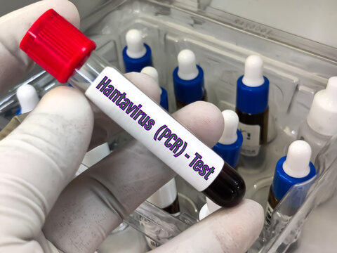 Biological Specimen blood test for detecting IgM and IgG antibodies (ELISA) or molecular PCR tests to detect viral RNA of Orthohantavirus or Hantavirus.