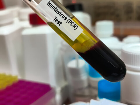 Biological Specimen blood test for detecting IgM and IgG antibodies (ELISA) or molecular PCR tests to detect viral RNA of Orthohantavirus or Hantavirus.