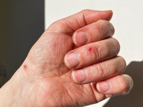 A close-up view of a healing burn on a woman's hand in natural light. A cut on finger. On the background of a white wall. Household accidents caused by hot and sharp appliances.