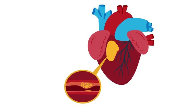 Animation of Arterial Plaque Buildup in Heart