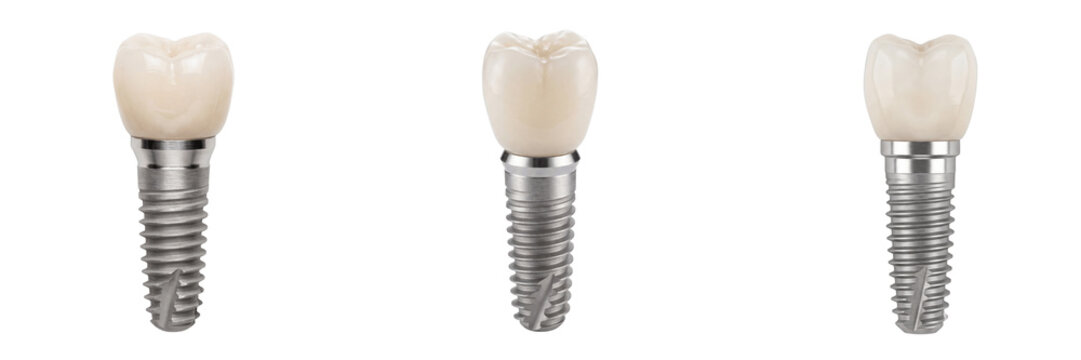 Dental implants with white teeth on metal screws isolated on transparent background,PNG