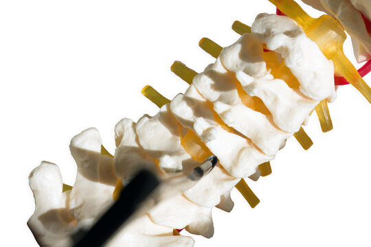 Cervical spine model demonstrating posterior laminectomy