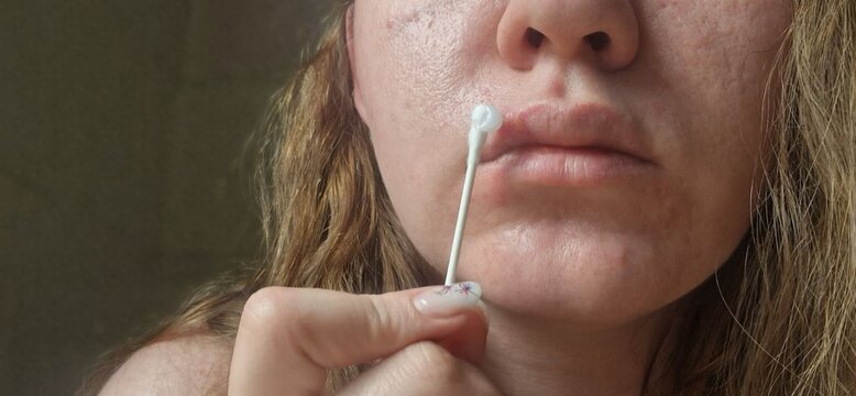 Close-up of a Woman Applying Medicinal Cream to a Herpes Sore on Her Lip Using a Cotton Swab. Treatment of Labial Herpes, Virus Infection and Dermatological Skin Care. Health and Pharmacy