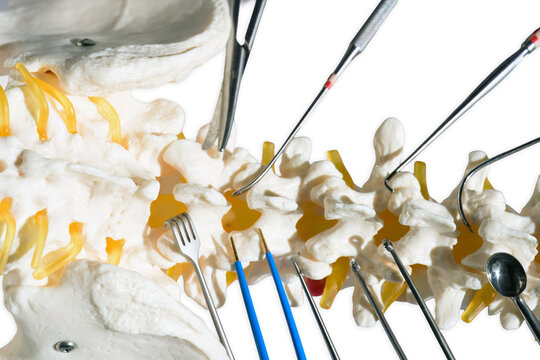 Lumbar spine model with posterior surgical instruments for decompression and stabilization. Anatomical vertebral column display showing specialized medical tools used for laminectomy and spinal fusion