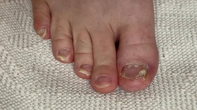 Onychomycosis of toenails by a patient. A dangerous fungal infection of toenails in a person. Disease and detachment of the nail plate. Regular cleaning and inspection