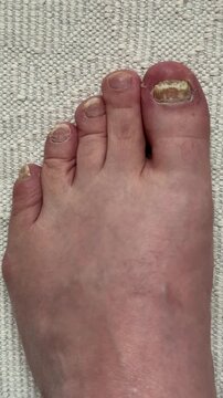 Onychomycosis. Dangerous fungal infection of human toenails on a white background at the doctor. Disease and detachment of the nail plate. Close-up