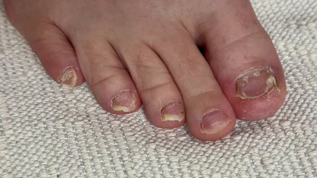 Onychomycosis of toenails by a patient. A dangerous fungal infection of toenails in a person. Disease and detachment of the nail plate. Regular cleaning and inspection