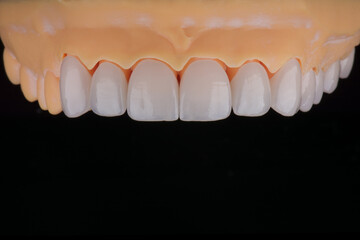 High-quality dental crowns made of zirconium for fixation to the teeth of upper jaw. © gorynvd