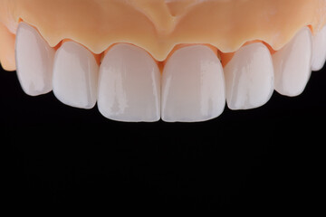 High-quality dental crowns made of zirconium for fixation to the teeth of upper jaw. © gorynvd