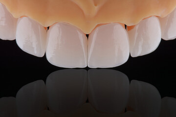 High-quality six dental crowns made of zirconium for fixation to the frontal teeth of upper jaw. © gorynvd