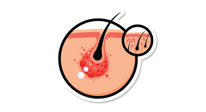 Skin Pimple Acne Closeup Illustration.