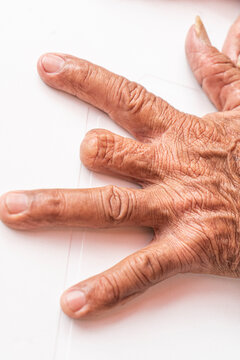 Person amputated a finger on the hand