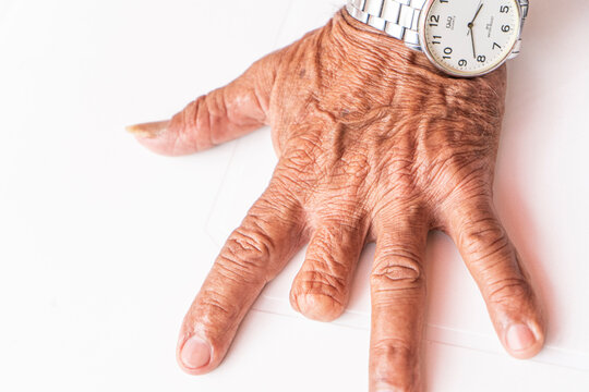 Person amputated a finger on the hand
