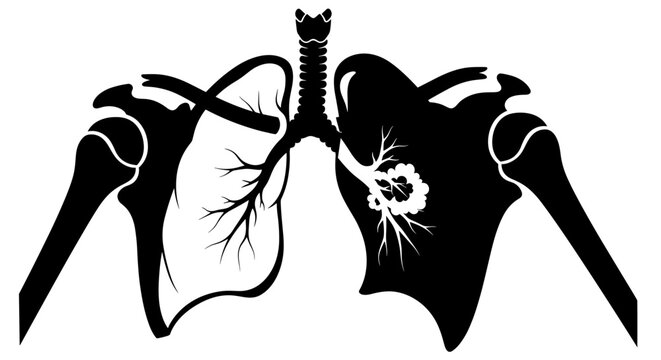 Black and white illustration of human lungs with pneumonia highlighted on one side, showcasing detailed bronchial structure and ray-like pattern in a medical diagram
