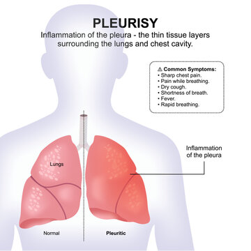 Pleurisy, Inflammed Lungs Infographic Illustration