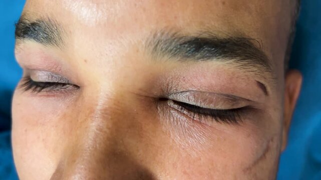 person with facial edema from insect bite showing redness and puffiness details