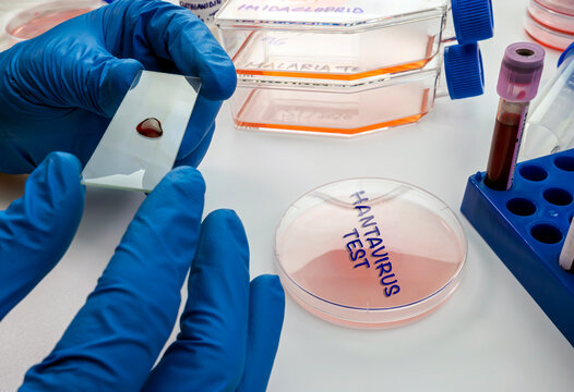 An epidemiologist is examining rodent blood to analyse the hantavirus outbreak in the laboratory