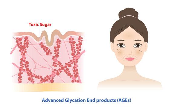 Cross section of skin layer excess sugar molecules bind to collagen and elastin. Skin glycation on woman face, resulting in premature aging, sagging, wrinkles and dull. Skin care and beauty concept.