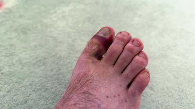 Close-up of injured foot with bruised toe on light carpet, showing visible swelling and discoloration, highlighting the need for medical attention and care