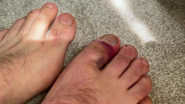 Close-up of injured toes with visible bruising and swelling on the right foot, natural light illuminating the skin texture on a soft carpet surface