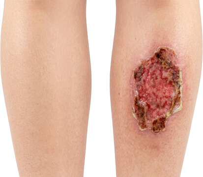 Comparison of a healthy human leg with a severe burn wound showing skin damage and healing process injury medical first degree second degree third degree scar pain inflammation