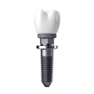 [Transparent Background PNG]Dental Implant with Ceramic Crown and Titanium Screw