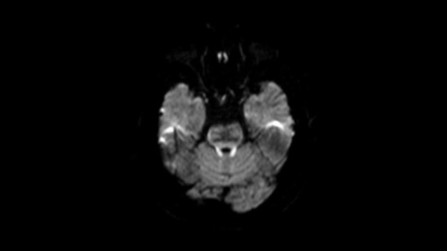 DWI MRI brain scan displaying diffusion-weighted imaging for the early detection of acute ischemic stroke.