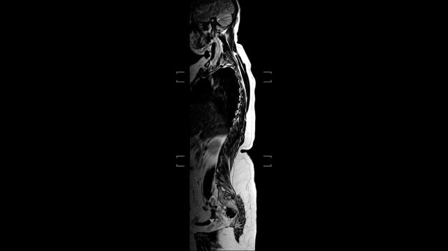 Advanced magnetic resonance imaging showing the lumbosacral region for clinical evaluation of spinal health and vertebral alignment.