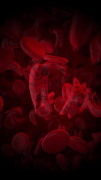 Sickle cell disease medical concept