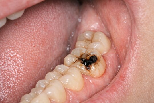 A close-up shot of a person's mouth showing a missing tooth