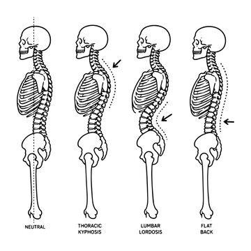 Spinal column alignment comparison of neutral thoracic kyphosis lumbar lordosis flat back.