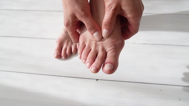 Female foot suffers from inflammation of the big toe bone. Hallux valgus, bunion in foot on white background. Close up
