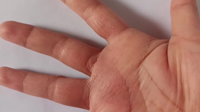 Video of asian woman palm with eczema or dermatitis causes dry, itchy, redness, peeling skin, irritation isolated on white background.