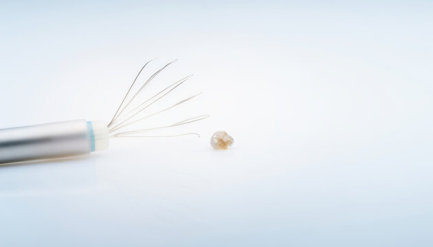 Kidney stone disease medical healthcare urology surgery treatment on white background with endoscope tool and removed calculus
