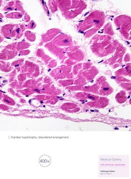 Left ventricular hypertrophy is seen in diseases such as hypertension. Histopathological changes include myocardial hypertrophy, disordered arrangement and fibrous hyperplasia.Magnify 400x.
