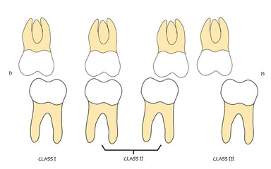 set of permanent molar teeth relationship classification (transparent background) © Ika
