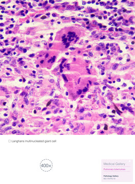 Langhans giant cells are multinucleated macrophages located at the periphery of a tuberculous nodule. Tuberculosis is a chronic granulomatous inflammation. Magnify 400x.
