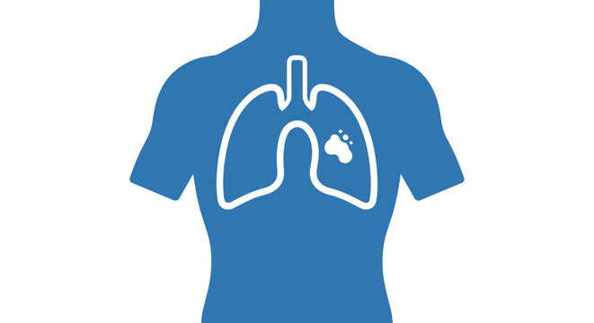 Blue silhouette of human torso with white outline of lungs and highlighted area symbolizing pneumonia, medical illustration with ray-like simplicity