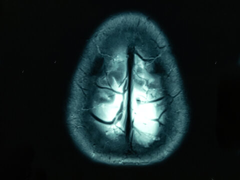 Magnetic resonance image (MRI) of the brain. MRI scan of human brain isolated black background.