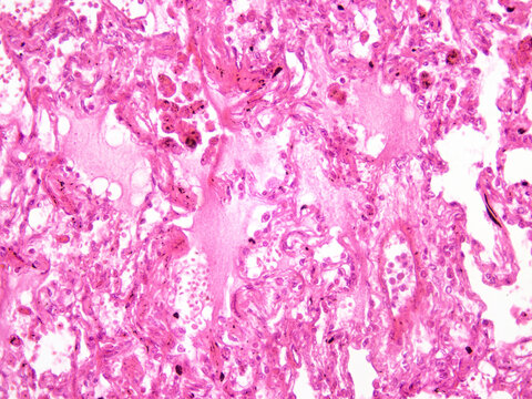 Mucinous adenocarcinoma of the lung is a distinct subtype of pulmonary adenocarcinoma; the neoplastic cells consist of goblet cells or tall columnar cells, and the tumor cells secrete copious amounts 