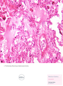 Mucinous adenocarcinoma of the lung is a distinct subtype of pulmonary adenocarcinoma; the neoplastic cells consist of goblet cells or tall columnar cells, and the tumor cells secrete copious amounts 