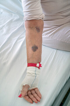 Side effects of anticoagulation therapy or blood-thinning medications: hematoma and large bruises on the arm of an elderly female patient in the hospital after blood draws